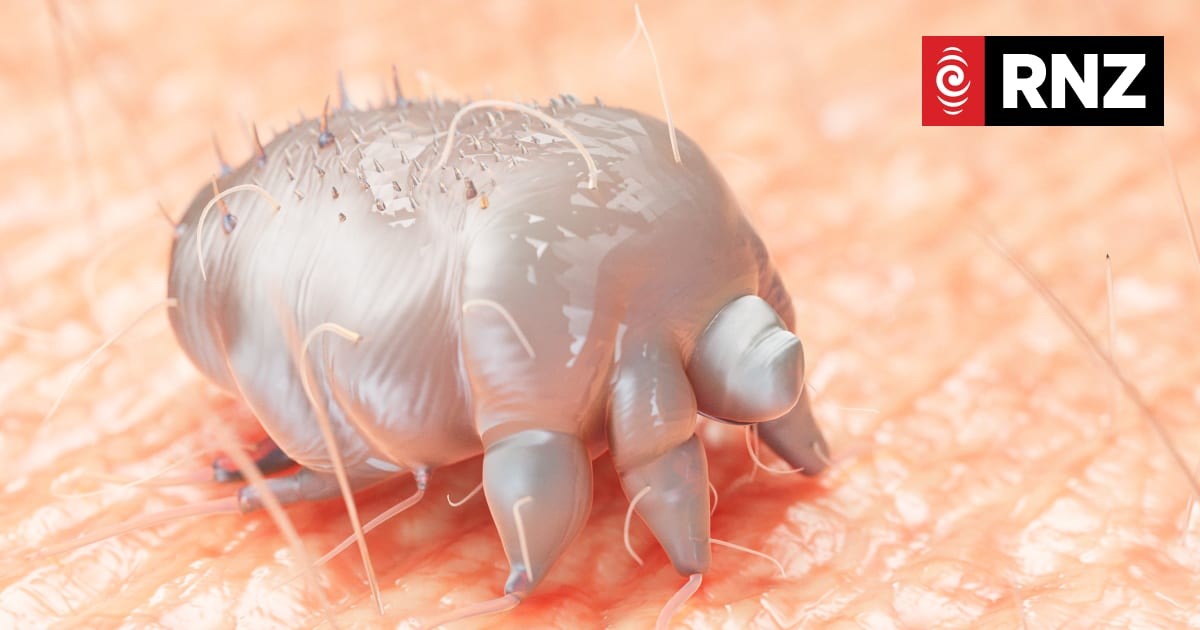 Whanganui's Scabies Outbreak Exposes Deeper Cracks in Our Social Safety Net